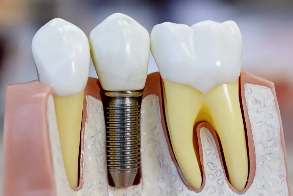 Understanding the Cost of Dental Implants Rogers AR