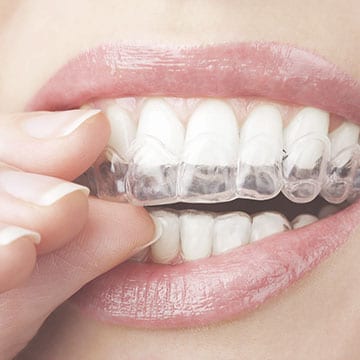 Clear Aligners in Rogers, AR