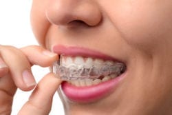 Woman wearing orthodontic clear aligners in Rogers, AR