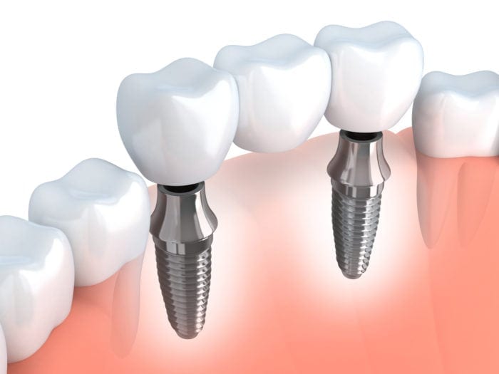 Dental implant secured dental bridge in rogers ar