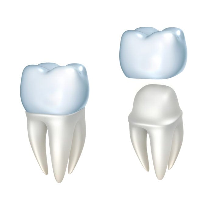 Affordable dental crown in Rogers, AR