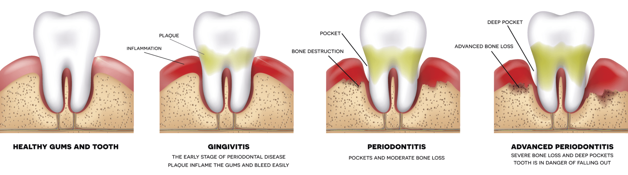 gum-disease-progression rogers ar