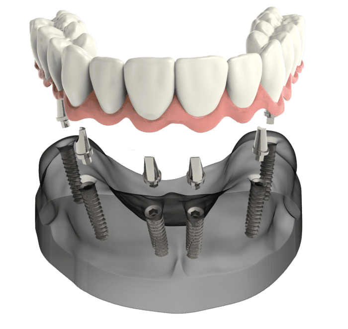 implant secured denture in rogers AR