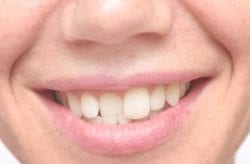 Dealing With Crooked Teeth in Rogers Arkansas