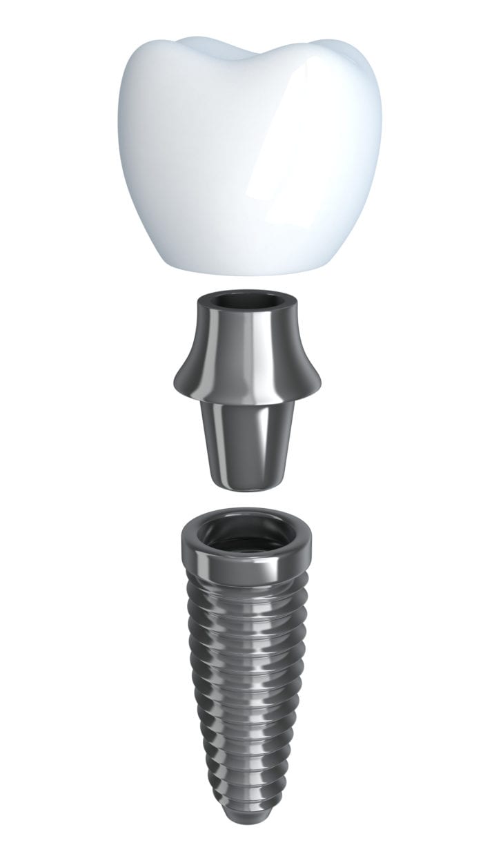 affordable dental implants in Rogers, AR