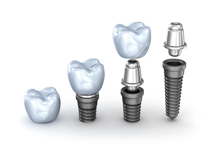 Dental Implants Process in Rogers, AR