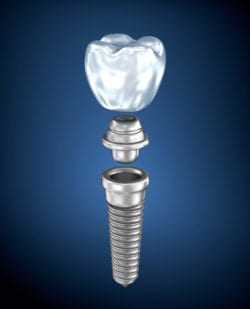 dental implants in rogers ar
