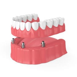 implant-supported denture in Rogers, AR