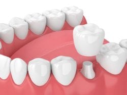 dental crowns in rogers, AR