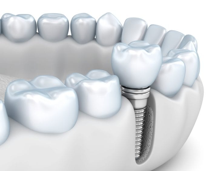 bone regeneration with dental implants in Rogers Arkansas