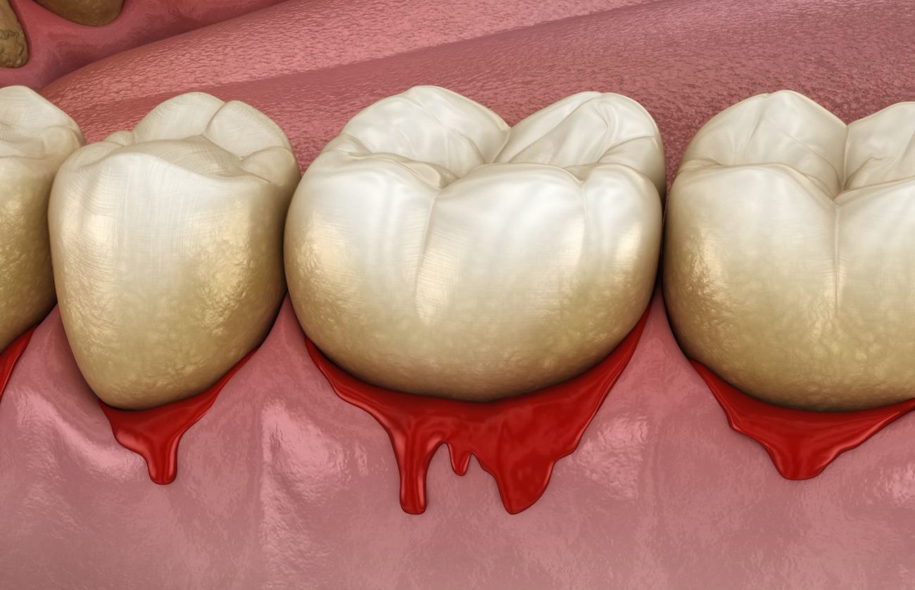 treat gum disease in Rogers Arkansas