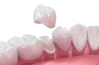 Patients often seek dental crowns after experiencing tooth decay or injury. Dentists also recommend crowns for large fillings.