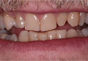 dave-p-mouth-before-300×207 dave-p-mouth-before-300x207