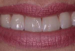 lillie-k-after-300×205 lillie-k-after-300x205