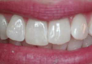 lillie-k-before-300x207