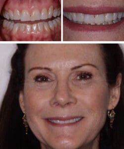 Before: Uneven front teeth distracted from Kelly's smile.
After: Kelly received Invisalign, whitening and composite veneer treatment to balance and enhance her smile.