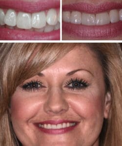 Before: Smile with severe crowding.
After: Invisalign braces and teeth whitening treatment.