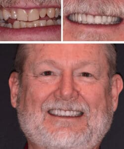 Before: Smile with crowding, missing tooth, irregular tooth size and shape, and tooth wear. After: Smile redesign that included treatment with Invisalign braces, implant crowns and porcelain crowns and veneers.