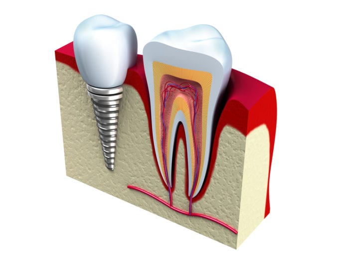 implant-supported dental crown in rogers, ar