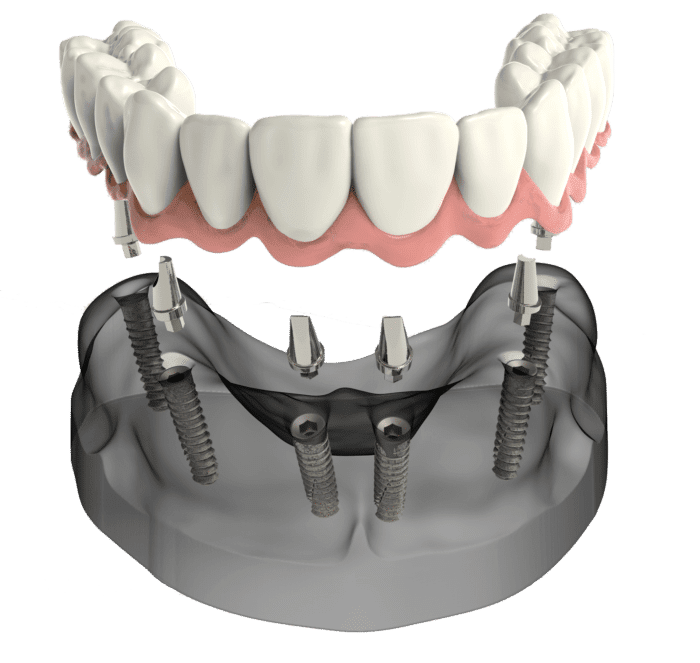 implant secured denture in Rogers, AR