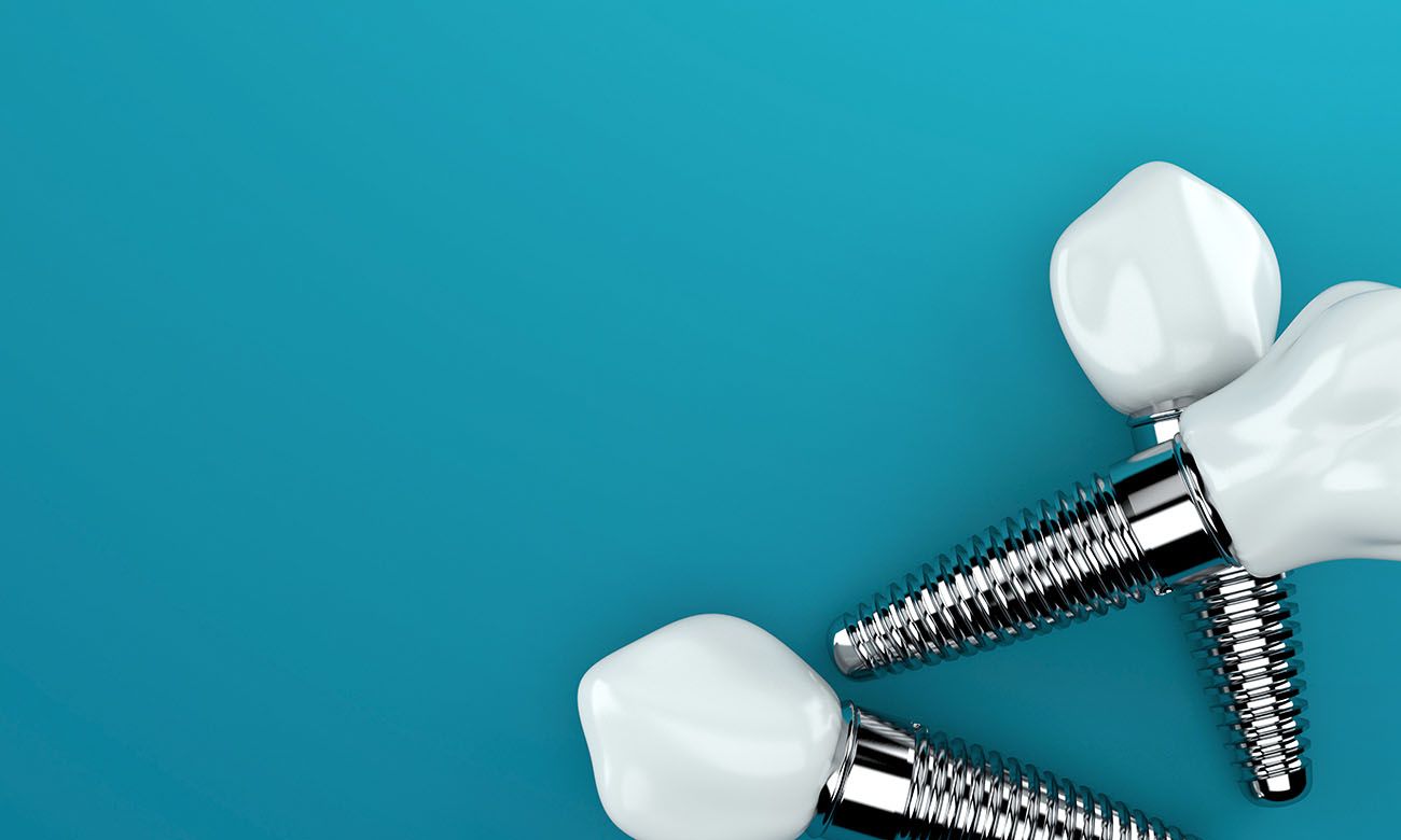 dental implants in Rogers, AR