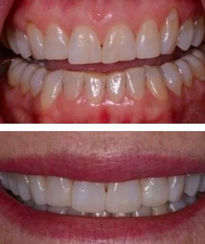 Before and After Smile Makeover Rogers AR