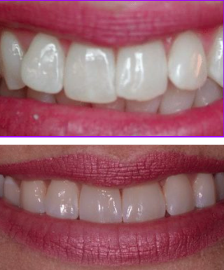 Before and After Invisalign Treatment