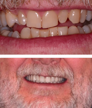 Before and After Restorative Dental Care Rogers AR