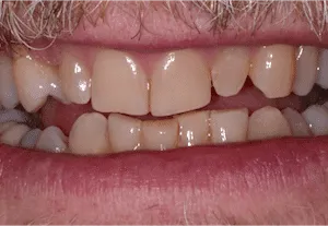 dave-p-mouth-before-300x207-1