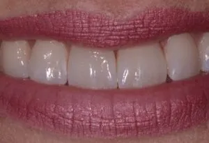 lillie-k-after-300x205-1