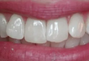 lillie-k-before-300x207-1